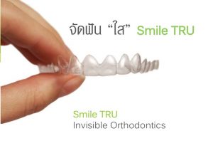 จัดฟันแบบใส เชียงใหม่ โดย cm dental clinic